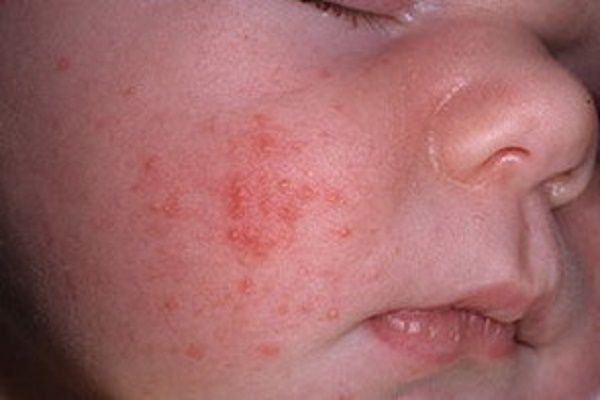 Фото 3 - Аллергия у ребенка