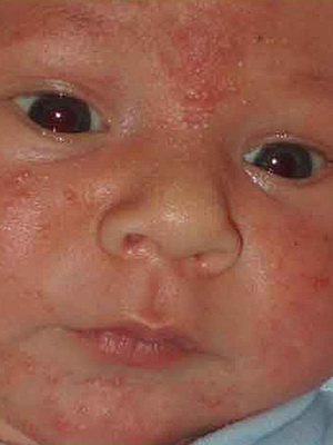 Покраснение на коже у новорожденных