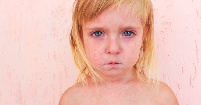Розеола у детей – симптомы, о которых важно знать родителям