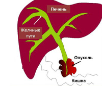 Механическая желтуха