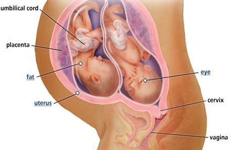 Маловодие при многоплодной беременности