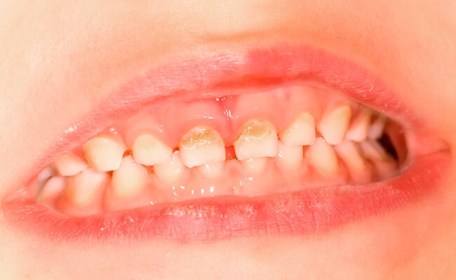 Белые пятна на зубах у ребенка
