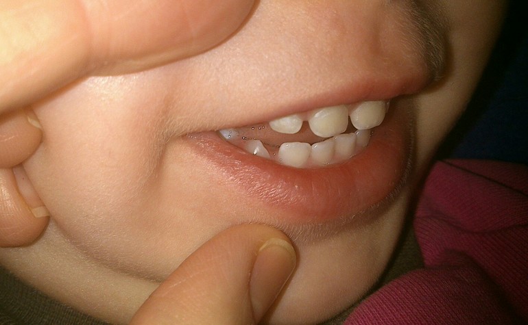Белые пятна на зубах у ребенка