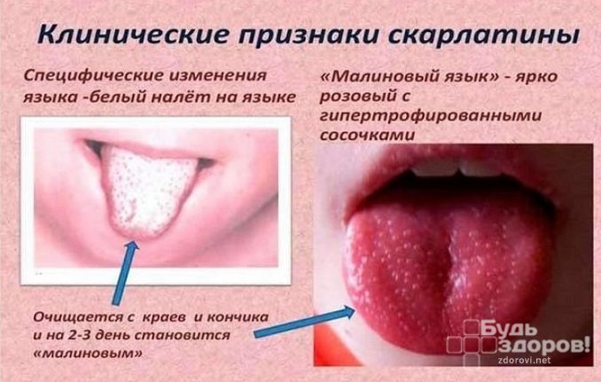 Изменение цвета языка при скарлатине у детей